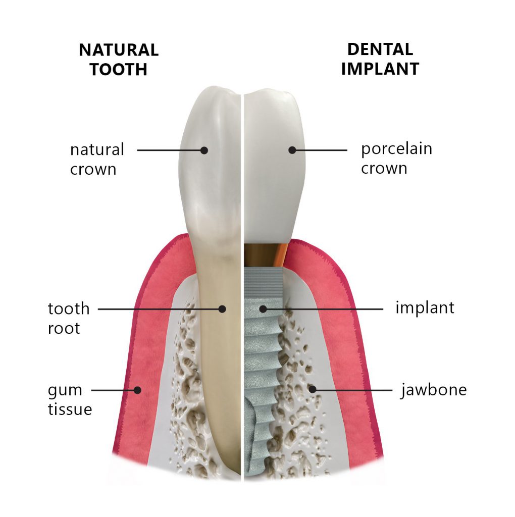 oakland-oral-surgery-dental-implant-center-implant-vs-natural-1020x1024.jpg?v=3